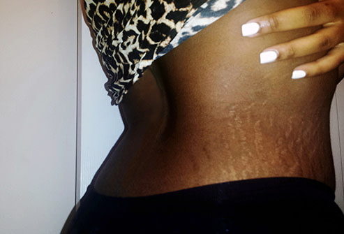 Stretch marks service in egbeda lagos by estreme therapy